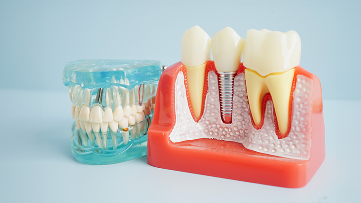 Especialidad en Implantologia Buco Maxilofacial